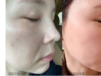 クリニカルボーテ 心斎橋院(CLINICAL BEAUTE)/インセルダムビフォーアフター