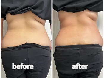 エミニーライフ(EMINY LIFE)/背中集中★1回で脂肪燃焼◎