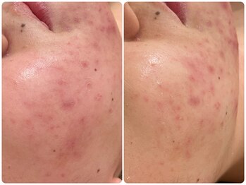 イデアルミー 大宮店(イデアルMe)の写真/水光肌ララピール/陶器肌ハーブピーリング！自分にあった肌管理がみつかる◎ワントーン明るいうる艶卵肌へ