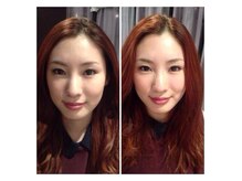 美容鍼1回の施術でお顔がキュッと引締り立体的に、顔色もUP！