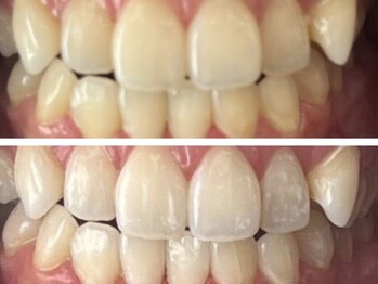 コハク(kohaku)/セルフホワイトニングを始めよう