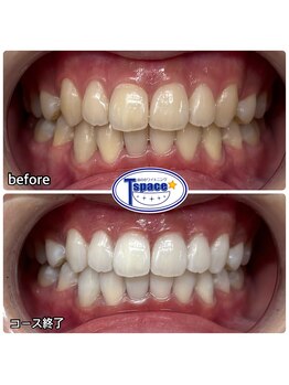 ティースペース(T-space)/クリスタルWhite Plus