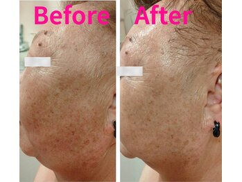 ハナノ つきのわ店(Hanano)/剥離なし肌育ピーリング