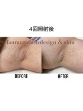 ファウラ(faura:)/ワキ脱毛