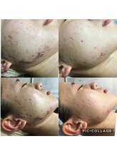 ビークレアーズ ビビ(B-crears. ViVi)/顔ハーブピーリング