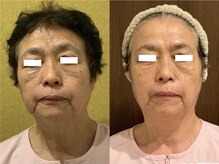 プリオール 太田店(Prior)/小顔コルギ