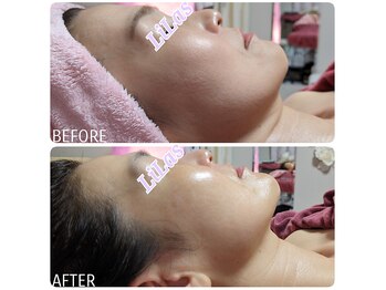 リラ(LiLas)/圧倒的つや肌!!小顔矯正まで!