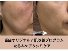 ジューンブライド(June Bride 61)/たるみケア⇒肌の深いお悩みも◎