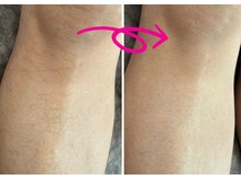 ベル(Belle)/照射しずらい産毛にも