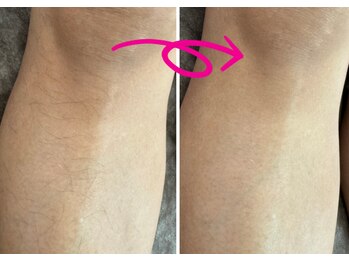 ベル(Belle)/照射しずらい産毛にも