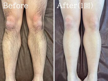 ルナステラ 金沢店/LED脱毛