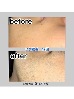 シュバル(CHEVAL)/めんどくさいひげ剃りから卒業！