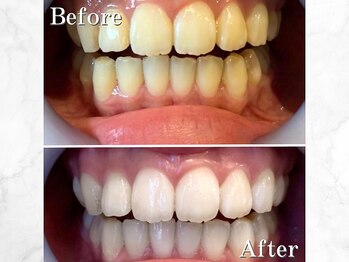 LBSホワイトニング 銀座店/セルフホワイトニングの症例写真