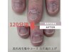 期間限定！【メンズ】深爪矯正モニター様募集！［本気で深爪を改善したい方】