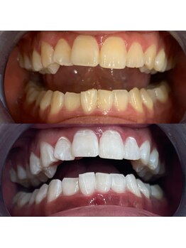 エクシアホワイトニング 新小岩店/ホワイトニングビフォーアフター