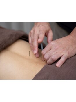 鍼灸施術を受けたい