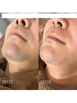 ランプ(LAMP)/~ハイブリッドヒゲ脱毛~