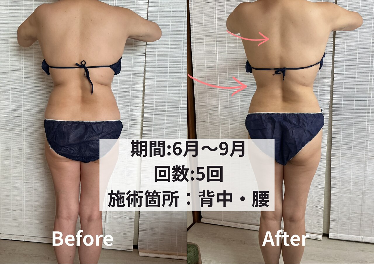 脂肪冷却③ クライオ360(Cryo360)｜ホットペッパービューティー