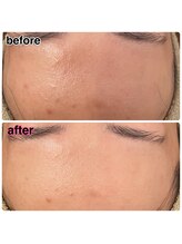 プルーム 久留米店(plume)/ハーブピーリング/ニキビケア