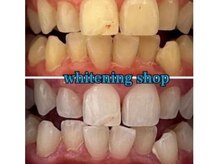 ホワイトニングショップ 鳥取店/ホワイトニングビフォーアフター