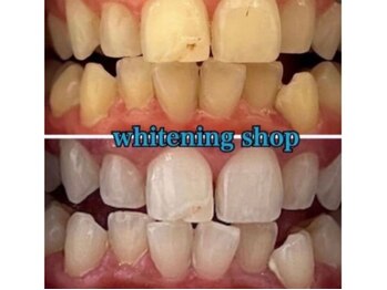 ホワイトニングショップ 鳥取店/ホワイトニングビフォーアフター