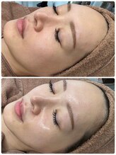 チップ(chip)/ララピール