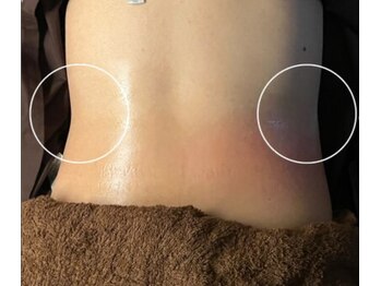 ロアー 赤坂店(RAWR)/カッピング痩身☆