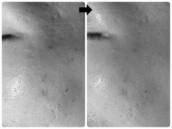 エフェクト 塚口店(effect)/Before After 40代/5回目