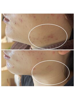 グリンプラス(grin+)/ハーブ/桂駅/フェイシャル