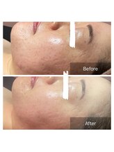 ヒール(heal)/毛穴お悩み