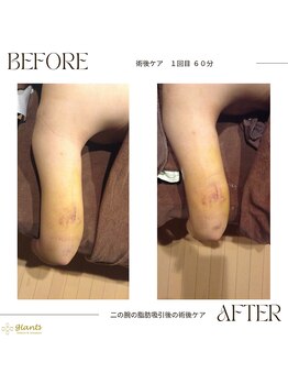 グランツ 小山店/二の腕の術後ケアのお客様１回目