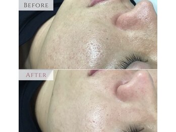 ドクターセリカ(Dr.SERIKA)/プラズマリフト