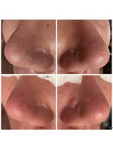 オルオル(Olu'olu)/ハイドラ毛穴洗浄フェイシャル