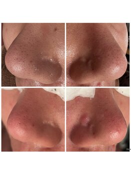 オルオル(Olu'olu)/美容液毛穴洗浄フェイシャル