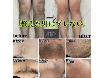 エリクサー 太田店(Elixir)/メンズ全身脱毛