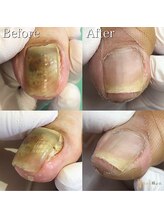 巻き爪補正店　豊橋店【巻き爪・魚の目・角質・副爪】【5月上旬オープン（予定）】/変形爪/肥厚爪