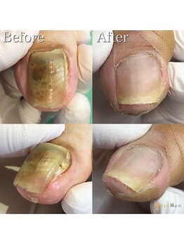 巻き爪補正店 豊橋店【巻き爪・魚の目・角質・副爪】【5月上旬オープン(予定)】/変形爪/肥厚爪