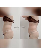 リブメイド(LIB maid)/フォースカッターお腹