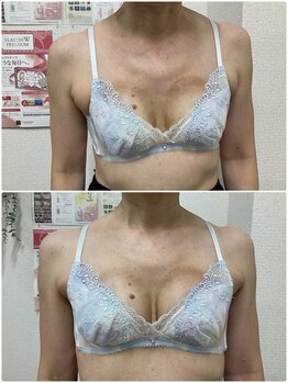 バーディー(BIRDIE)/施術3回/50代/AA→B