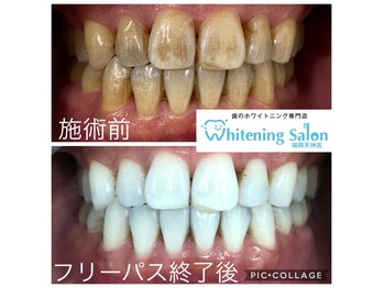 ホワイトニングサロン 福岡天神店
