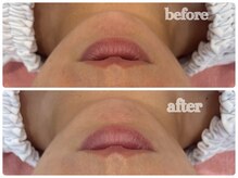 シルク(Cilk)/リフトアップマッサージ