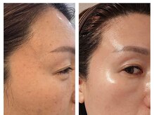 クリニカルボーテ 心斎橋院(CLINICAL BEAUTE)/インセルダムビフォーアフター