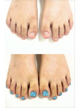 ピノ(pino)の写真/フット深爪矯正で、自信を持ってサンダルを履ける美しい足へ♪【foot深爪矯正＋ワンカラー￥17000】