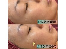 リンパクリニークアリスの雰囲気（シミケア４回目で薄くなりました♪上のお写真。）