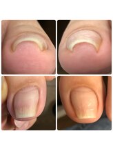 ネイル ウォッカ(NAiL VODKa)/【巻き爪ケア(B/S)】