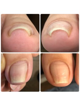 ネイル ウォッカ(NAiL VODKa)/【巻き爪ケア(B/S)】