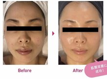 Nビューティー/最新RFサーモシェイプオーパス