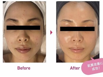 Nビューティー/最新RFサーモシェイプオーパス