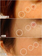 サロンツキ(salon tuki)/最新光機器★症例