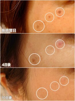 サロンツキ(salon tuki)/最新光機器★症例